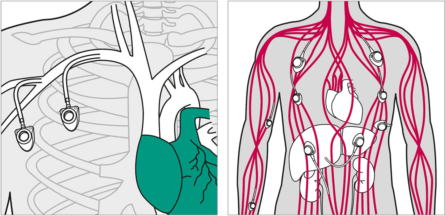 Illustrations des voies d’accès potentielles pour un cathéter à port vasculaire veineux central